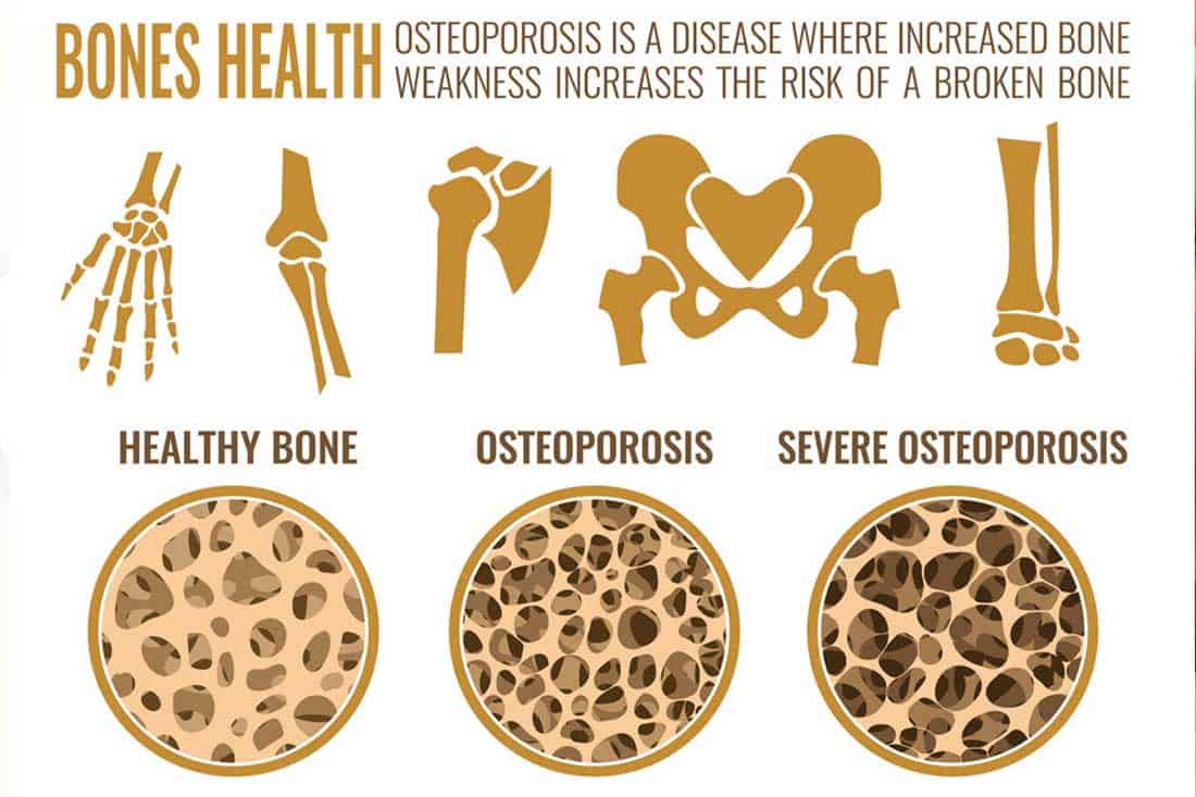 Ezfit Blog What Does Bone Density Mean