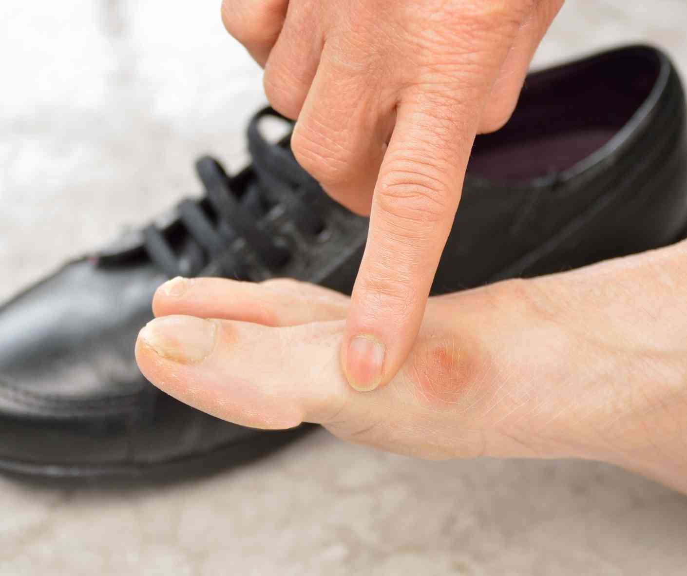 What Causes Bunions? What To Know About This Painful Condition?