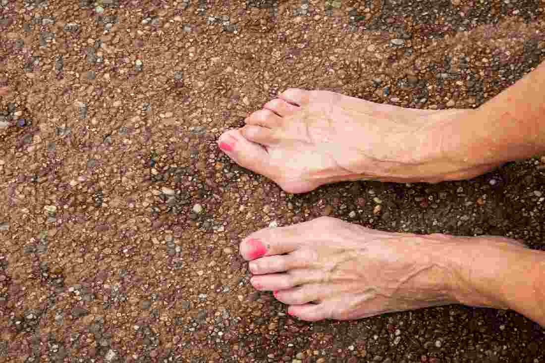 Hammertoes