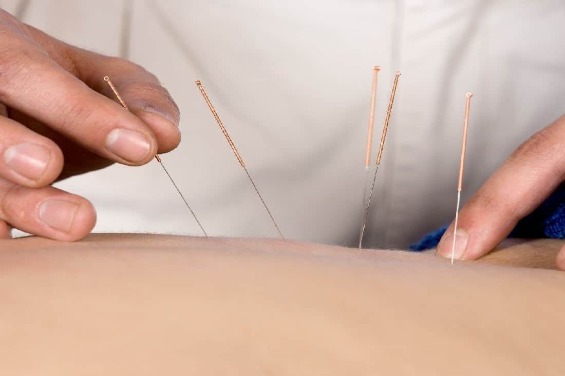 7 Potential Health Benefits of Acupuncture