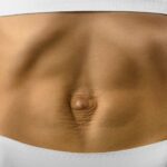Spotlight on Rectus Diastasis